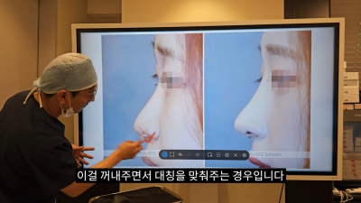 돌출입코성형, 비순각 각도와 비주내리기 수술의 관계성 - 1편 사진 31