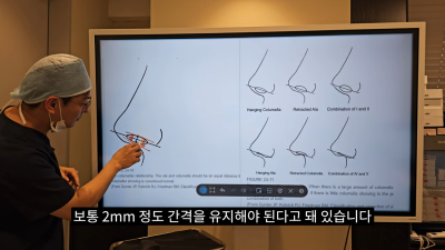 돌출입코성형, 비순각 각도와 비주내리기 수술의 관계성 - 1편 사진 6