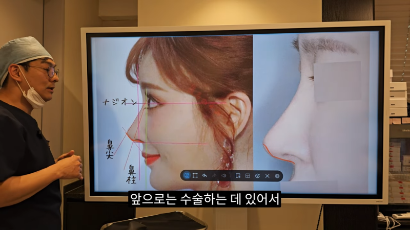 사각코성형 방법으로 돌출입개선효과와 자연스러운코를 만들어 보세요. 사진 21