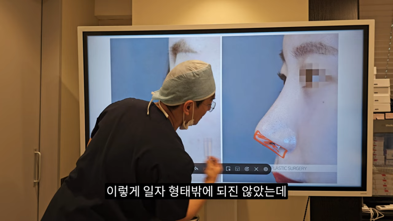 사각코성형 방법으로 돌출입개선효과와 자연스러운코를 만들어 보세요. 사진 15
