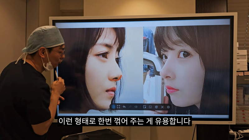사각코성형 방법으로 돌출입개선효과와 자연스러운코를 만들어 보세요. 사진 20