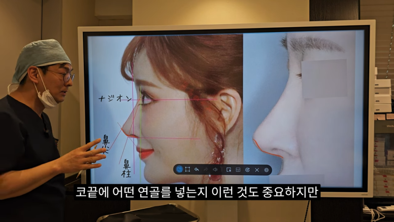 사각코성형 방법으로 돌출입개선효과와 자연스러운코를 만들어 보세요. 사진 22