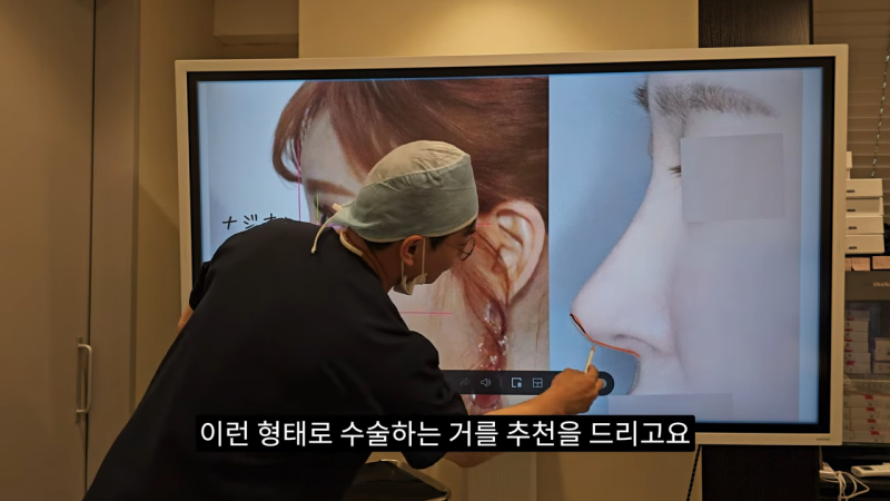 사각코성형 방법으로 돌출입개선효과와 자연스러운코를 만들어 보세요. 사진 25