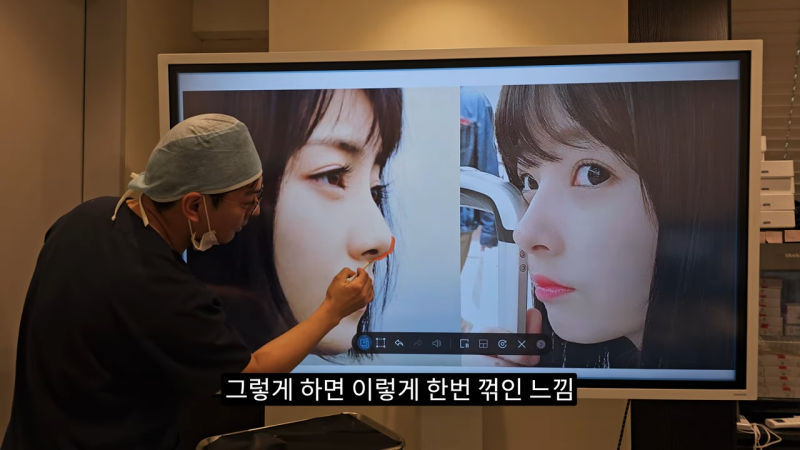 사각코성형 방법으로 돌출입개선효과와 자연스러운코를 만들어 보세요. 사진 17