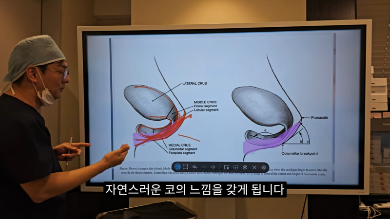 사각코성형 방법으로 돌출입개선효과와 자연스러운코를 만들어 보세요. 사진 13