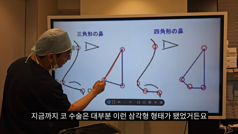 사각코성형 방법으로 돌출입개선효과와 자연스러운코를 만들어 보세요. 사진 3