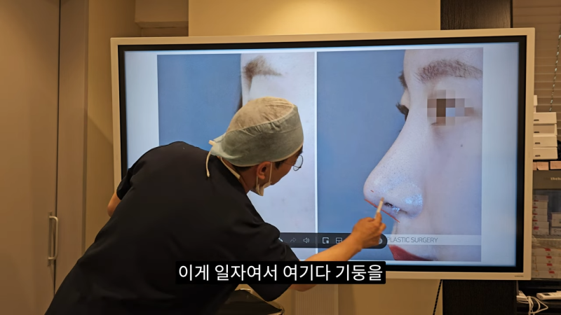 사각코성형 방법으로 돌출입개선효과와 자연스러운코를 만들어 보세요. 사진 14