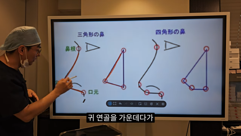 사각코성형 방법으로 돌출입개선효과와 자연스러운코를 만들어 보세요. 사진 5