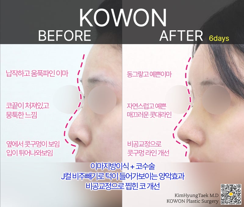 사각코성형 방법으로 돌출입개선효과와 자연스러운코를 만들어 보세요. 사진 16