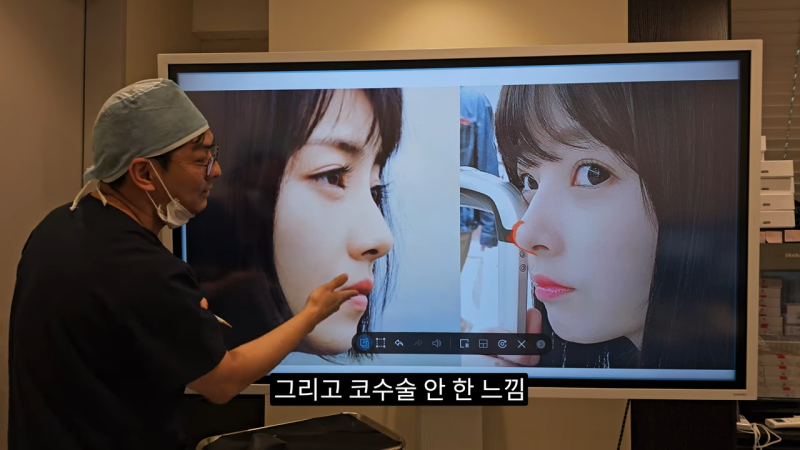 사각코성형 방법으로 돌출입개선효과와 자연스러운코를 만들어 보세요. 사진 19