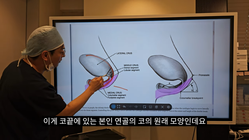 사각코성형 방법으로 돌출입개선효과와 자연스러운코를 만들어 보세요. 사진 11