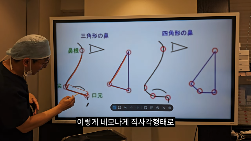 사각코성형 방법으로 돌출입개선효과와 자연스러운코를 만들어 보세요. 사진 6