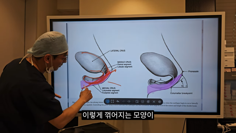 사각코성형 방법으로 돌출입개선효과와 자연스러운코를 만들어 보세요. 사진 12