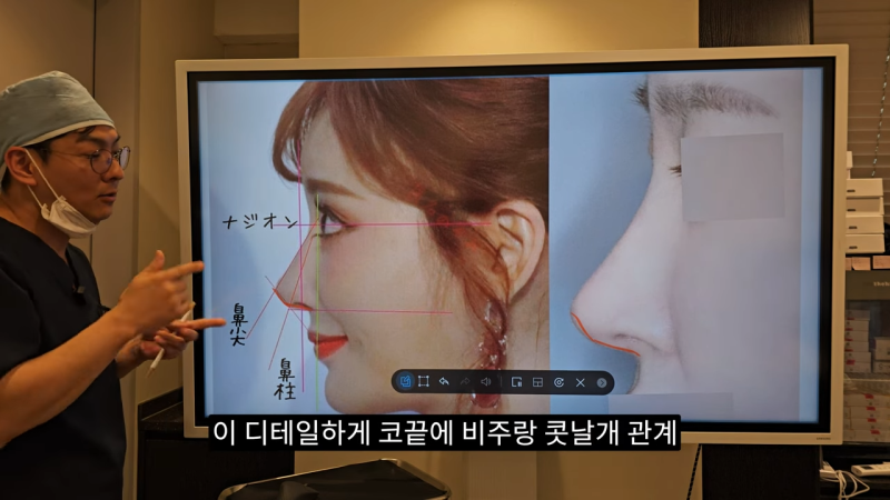 사각코성형 방법으로 돌출입개선효과와 자연스러운코를 만들어 보세요. 사진 23