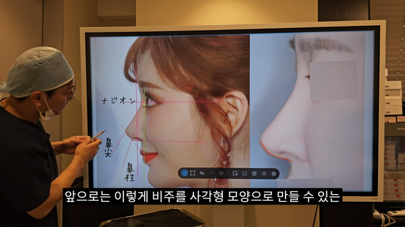 사각코성형 방법으로 돌출입개선효과와 자연스러운코를 만들어 보세요. 사진 24
