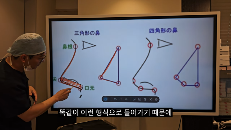 사각코성형 방법으로 돌출입개선효과와 자연스러운코를 만들어 보세요. 사진 8