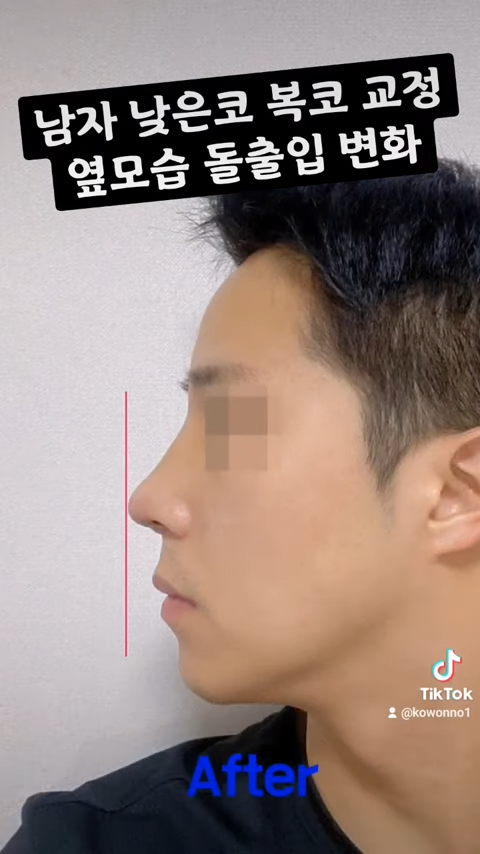 비순각 교정으로 돌출입교정까지 한 번에 해결! 사진 6