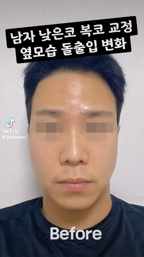 비순각 교정으로 돌출입교정까지 한 번에 해결! 사진 3