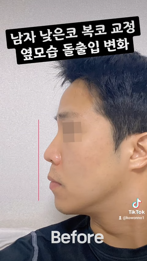 비순각 교정으로 돌출입교정까지 한 번에 해결! 사진 5