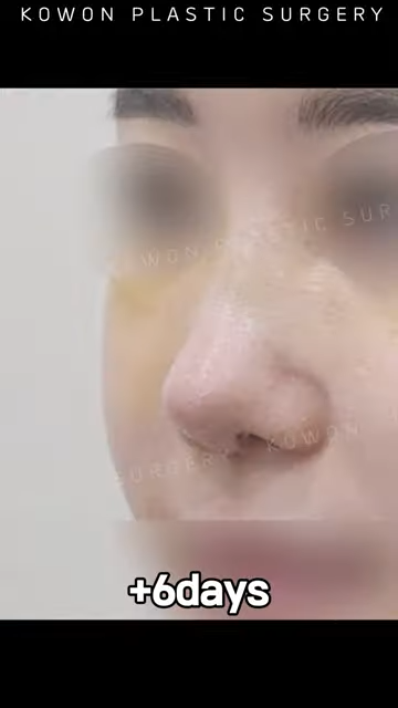 비순각 교정으로 돌출입교정까지 한 번에 해결! 사진 10