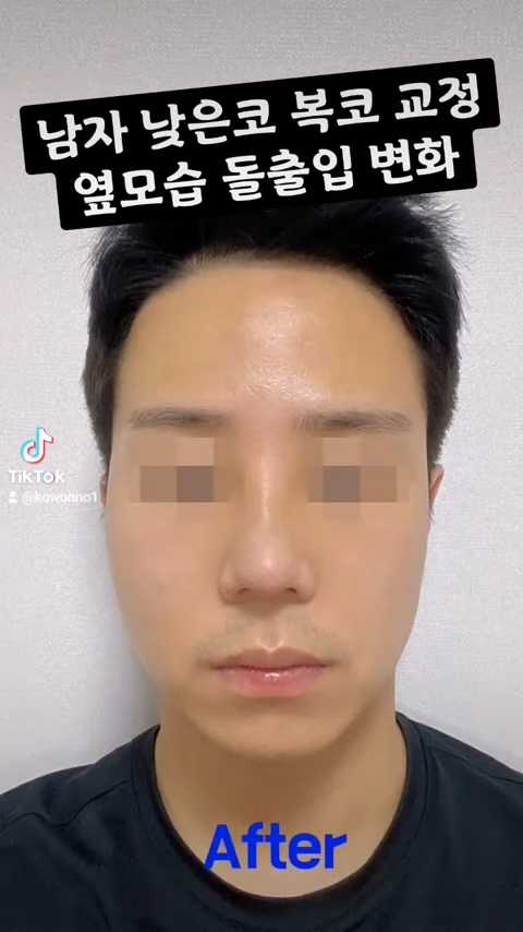 비순각 교정으로 돌출입교정까지 한 번에 해결! 사진 4