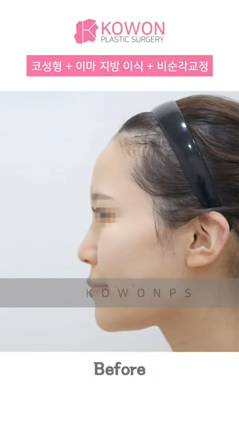 비순각 교정으로 돌출입교정까지 한 번에 해결! 사진 11
