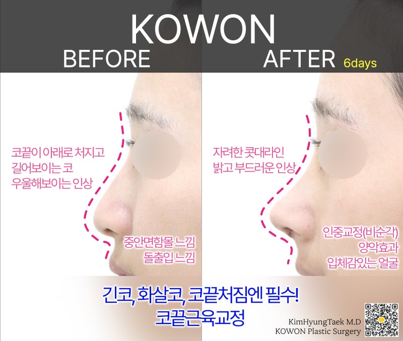 비순각 교정으로 돌출입교정까지 한 번에 해결!