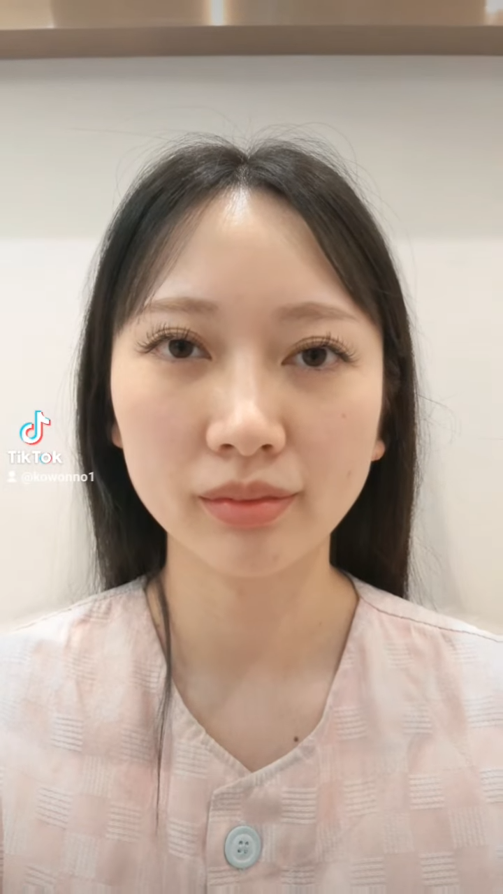 비순각수술하고 코보형물 움직임, 비주붓기 증세가 있어요! 해결 방법은? 사진 10