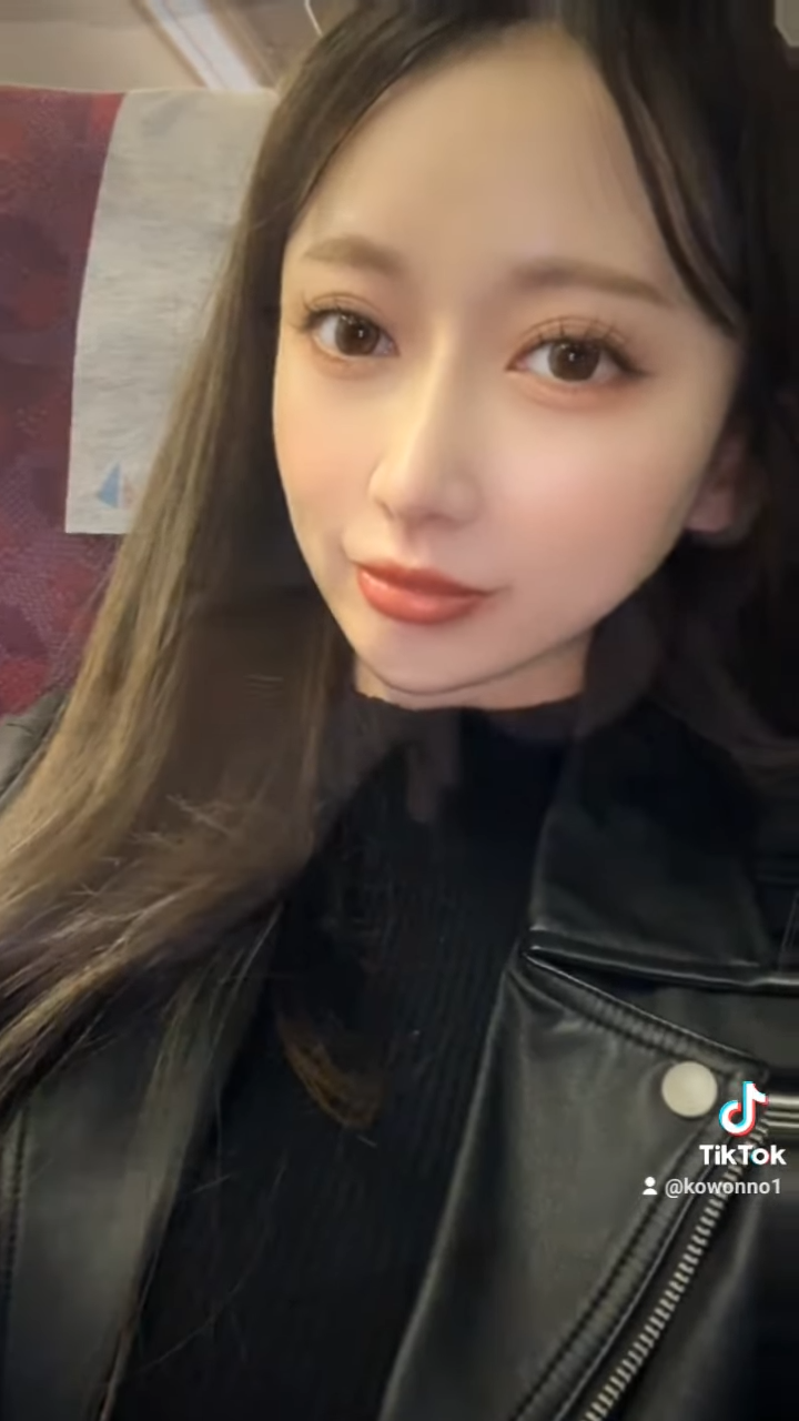 비순각수술하고 코보형물 움직임, 비주붓기 증세가 있어요! 해결 방법은? 사진 12