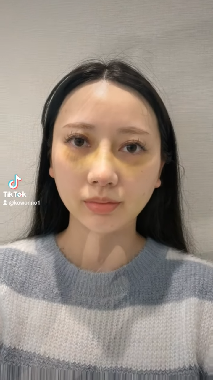 비순각수술하고 코보형물 움직임, 비주붓기 증세가 있어요! 해결 방법은? 사진 11