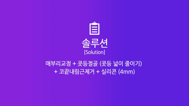 매부리교정, 코끝내림근제거 수술 후 낮은코에서 높은 콧대로 변화한 사례 사진 3