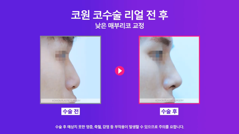 매부리교정, 코끝내림근제거 수술 후 낮은코에서 높은 콧대로 변화한 사례 사진 8