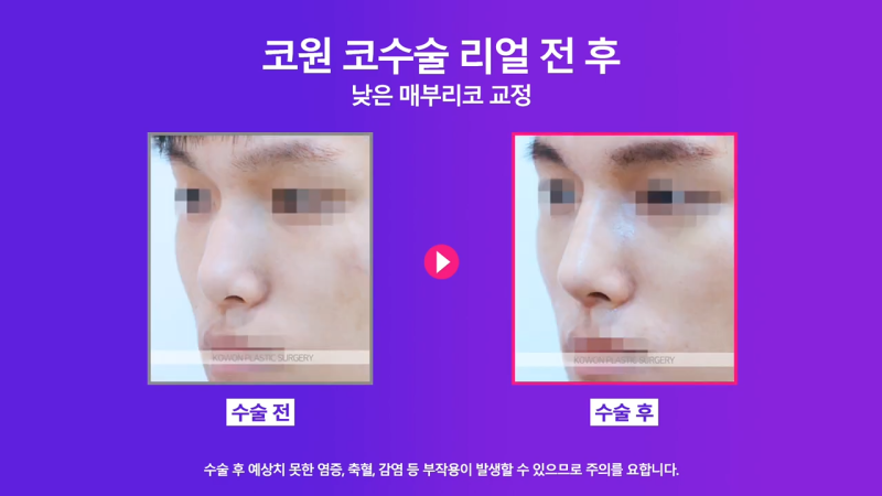 매부리교정, 코끝내림근제거 수술 후 낮은코에서 높은 콧대로 변화한 사례 사진 7
