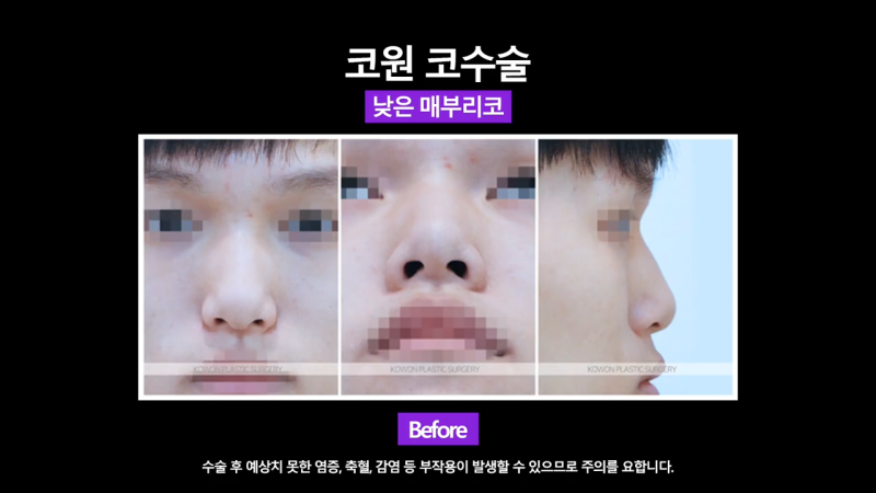 매부리교정, 코끝내림근제거 수술 후 낮은코에서 높은 콧대로 변화한 사례 사진 4
