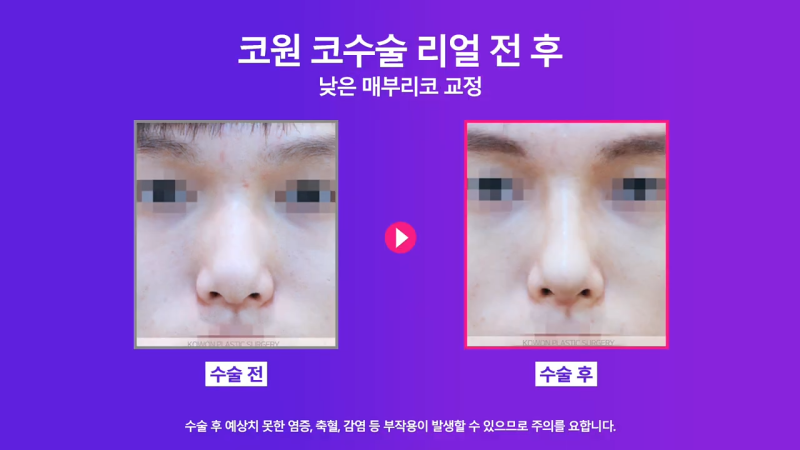 매부리교정, 코끝내림근제거 수술 후 낮은코에서 높은 콧대로 변화한 사례 사진 5