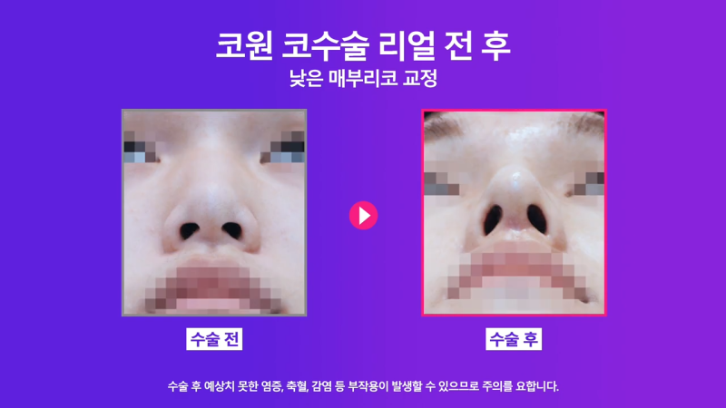 매부리교정, 코끝내림근제거 수술 후 낮은코에서 높은 콧대로 변화한 사례 사진 6