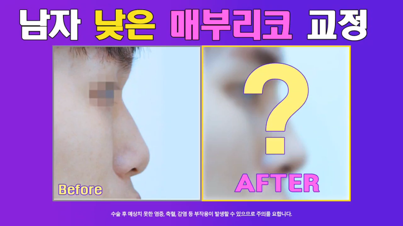 매부리교정, 코끝내림근제거 수술 후 낮은코에서 높은 콧대로 변화한 사례