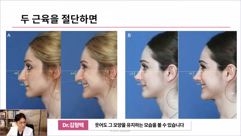 화살코성형 후 처진코가 되는 원인은 코끝내림근 때문? 사진 9