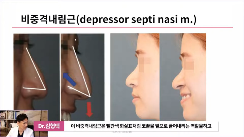 화살코성형 후 처진코가 되는 원인은 코끝내림근 때문? 사진 3