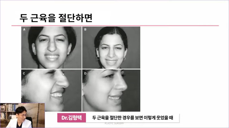 화살코성형 후 처진코가 되는 원인은 코끝내림근 때문? 사진 6