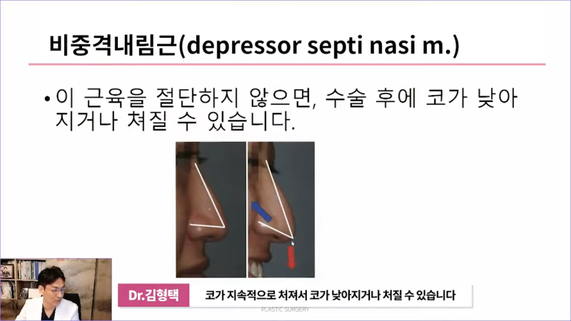 화살코성형 후 처진코가 되는 원인은 코끝내림근 때문? 사진 5