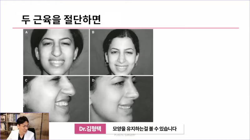 화살코성형 후 처진코가 되는 원인은 코끝내림근 때문? 사진 8