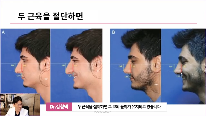 화살코성형 후 처진코가 되는 원인은 코끝내림근 때문? 사진 11
