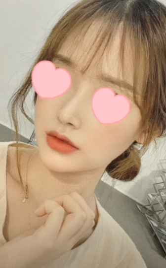 긴코수술은 어떻게 이루어질까? 그리고 화살코, 처진코원인은? 사진 14