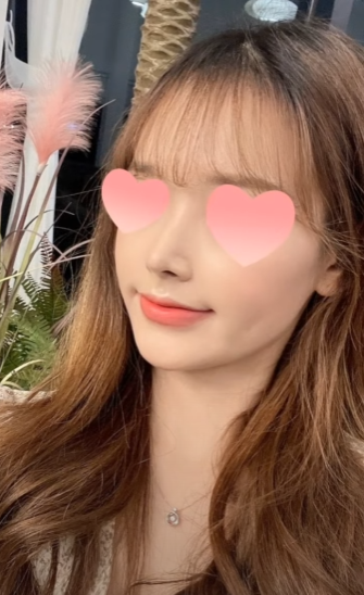 긴코수술은 어떻게 이루어질까? 그리고 화살코, 처진코원인은? 사진 15