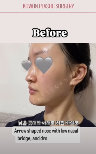 긴코수술은 어떻게 이루어질까? 그리고 화살코, 처진코원인은? 사진 8