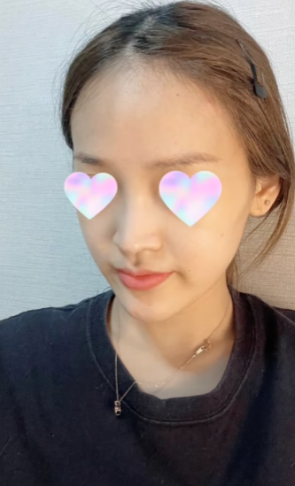긴코수술은 어떻게 이루어질까? 그리고 화살코, 처진코원인은? 사진 12