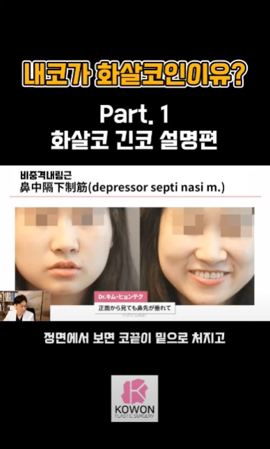 긴코수술은 어떻게 이루어질까? 그리고 화살코, 처진코원인은? 사진 6