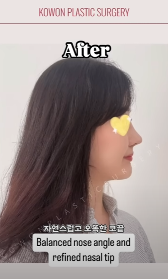긴코수술은 어떻게 이루어질까? 그리고 화살코, 처진코원인은? 사진 11