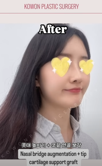 긴코수술은 어떻게 이루어질까? 그리고 화살코, 처진코원인은? 사진 10